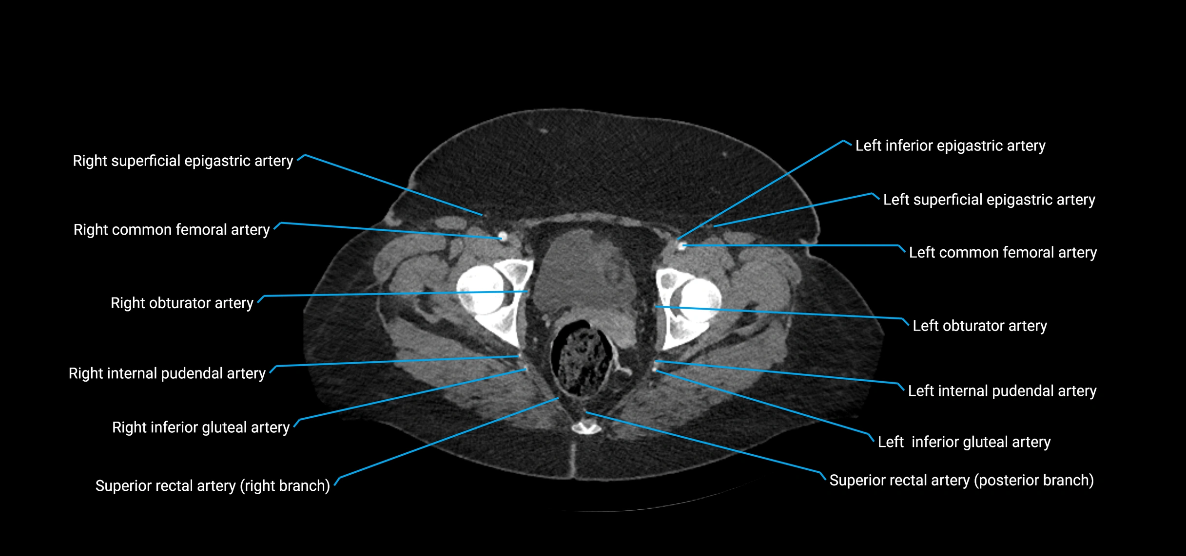 CTA abdomen axial cross sectional anatomy labelled image_242 (2).webp